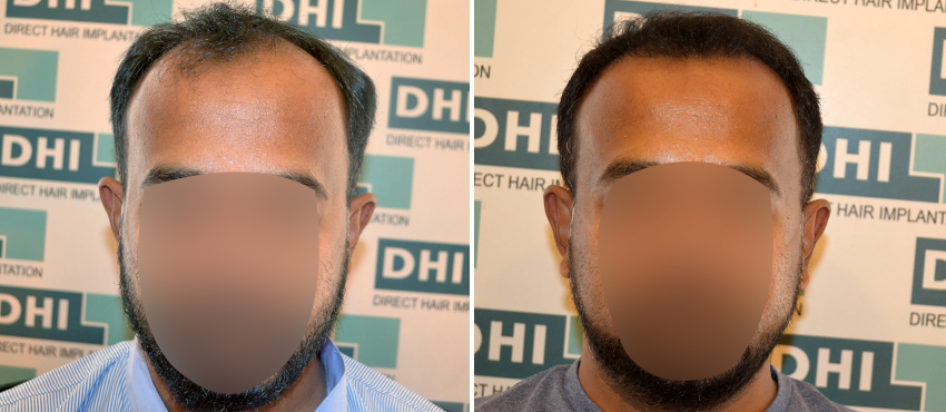 DHI before & after hair transplant results